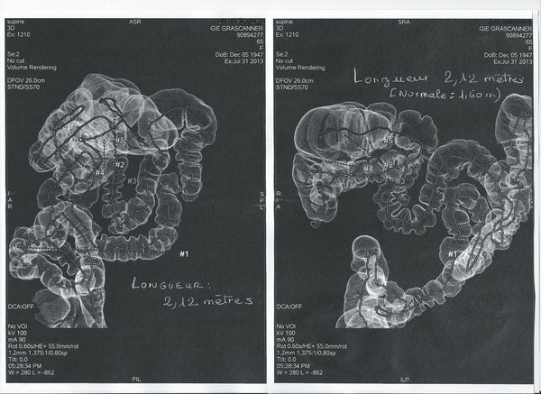 scanner long colon vue de de 3/4