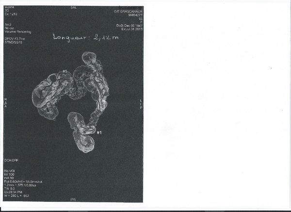 scanner long colon vue de face